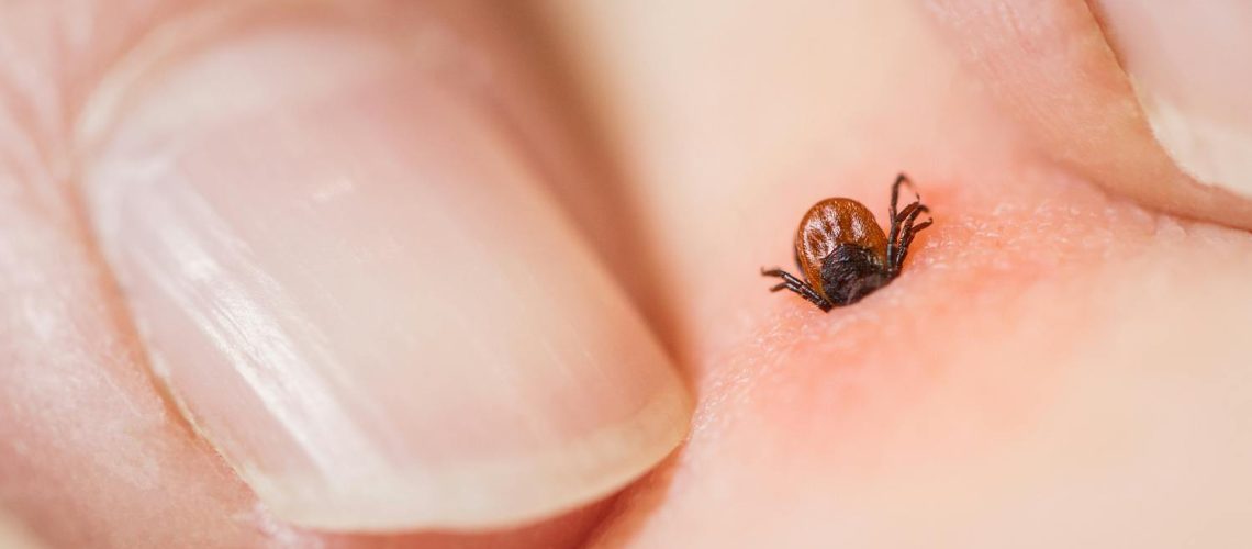 Tiques : est-ce efficace d'utiliser une pince à épiler ?